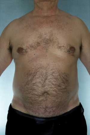 Liposuction Before & After Patient #8752