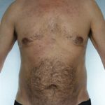 Liposuction Before & After Patient #8752