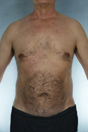 Liposuction Before & After Patient #8752