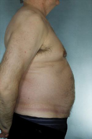 Liposuction Before & After Patient #8752