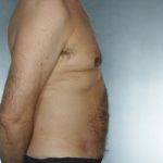 Liposuction Before & After Patient #8752