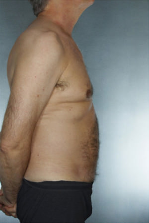 Liposuction Before & After Patient #8752