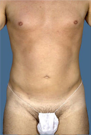 Liposuction Before & After Patient #8757
