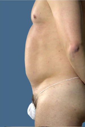 Liposuction Before & After Patient #8757