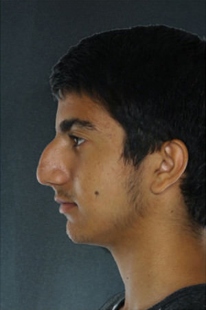 Rhinoplasty Before & After Patient #8914