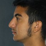 Rhinoplasty Before & After Patient #8914
