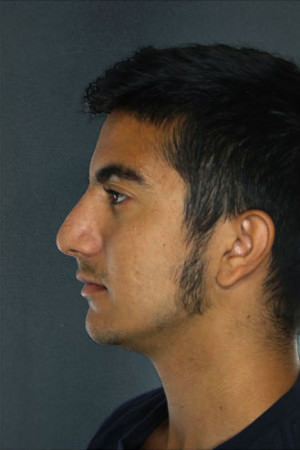 Rhinoplasty Before & After Patient #8914