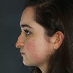 Rhinoplasty Before & After Patient #8919