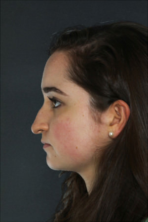 Rhinoplasty Before & After Patient #8919