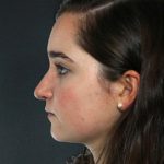 Rhinoplasty Before & After Patient #8919