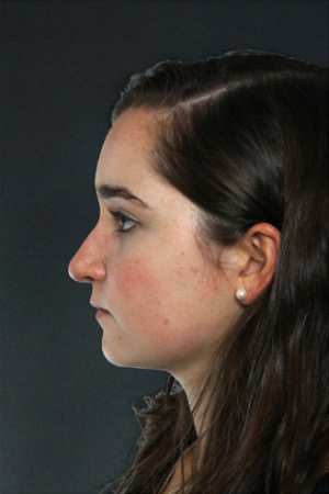 Rhinoplasty Before & After Patient #8919