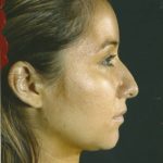 Rhinoplasty Before & After Patient #8929
