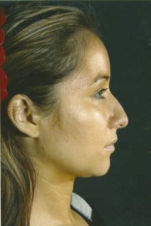 Rhinoplasty Before & After Patient #8929