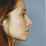 Rhinoplasty Before & After Patient #8929