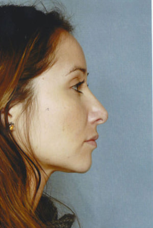 Rhinoplasty Before & After Patient #8929