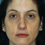 Rhinoplasty Before & After Patient #8934