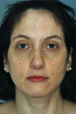 Rhinoplasty Before & After Patient #8934