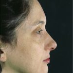 Rhinoplasty Before & After Patient #8934