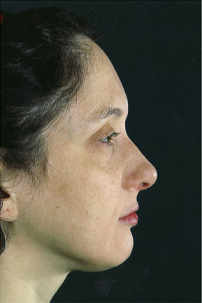 Rhinoplasty Before & After Patient #8934