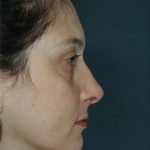 Rhinoplasty Before & After Patient #8934