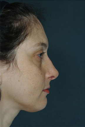 Rhinoplasty Before & After Patient #8934