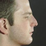 Rhinoplasty Before & After Patient #8941