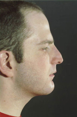 Rhinoplasty Before & After Patient #8941