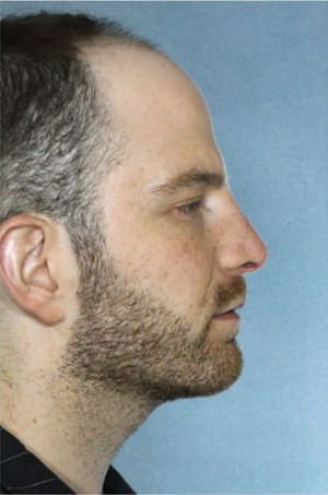 Rhinoplasty Before & After Patient #8941