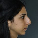 Rhinoplasty Before & After Patient #8946