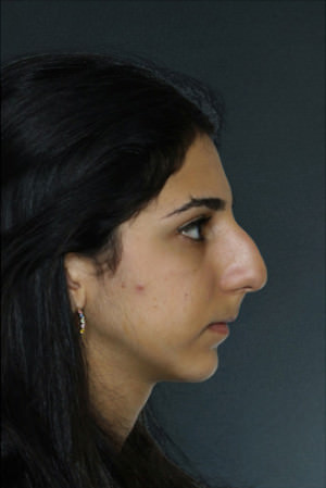 Rhinoplasty Before & After Patient #8946