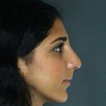 Rhinoplasty Before & After Patient #8946