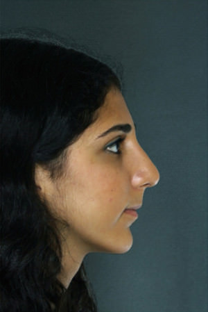 Rhinoplasty Before & After Patient #8946