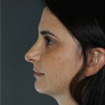 Rhinoplasty Before & After Patient #8951