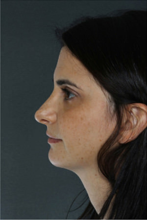 Rhinoplasty Before & After Patient #8951