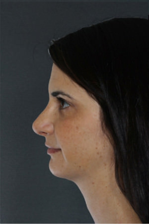 Rhinoplasty Before & After Patient #8951