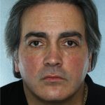 Rhinoplasty Before & After Patient #8958