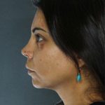 Rhinoplasty Before & After Patient #8963