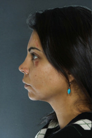 Rhinoplasty Before & After Patient #8963