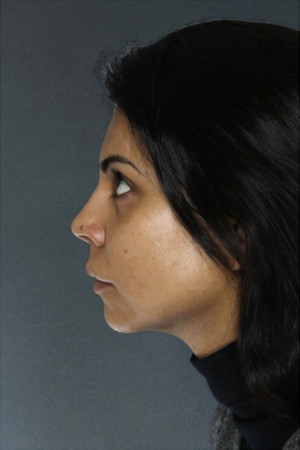Rhinoplasty Before & After Patient #8963
