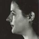 Rhinoplasty Before & After Patient #8968