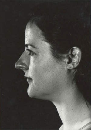 Rhinoplasty Before & After Patient #8968