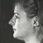 Rhinoplasty Before & After Patient #8968