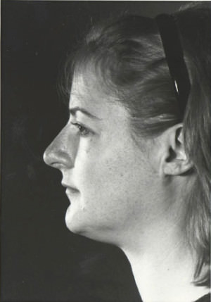 Rhinoplasty Before & After Patient #8968