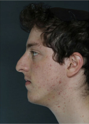 Rhinoplasty Before & After Patient #8975