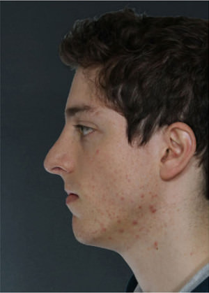 Rhinoplasty Before & After Patient #8975