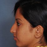Rhinoplasty Before & After Patient #8985