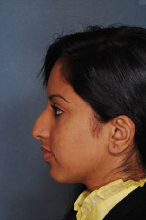 Rhinoplasty Before & After Patient #8985