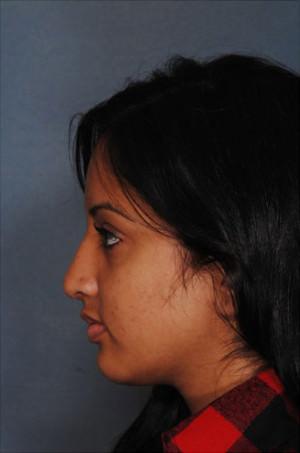 Rhinoplasty Before & After Patient #8985