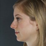 Rhinoplasty Before & After Patient #8996