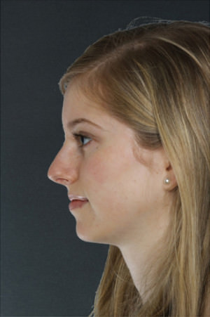 Rhinoplasty Before & After Patient #8996